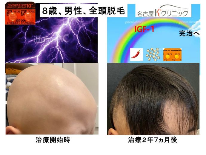 円形脱毛症　病院